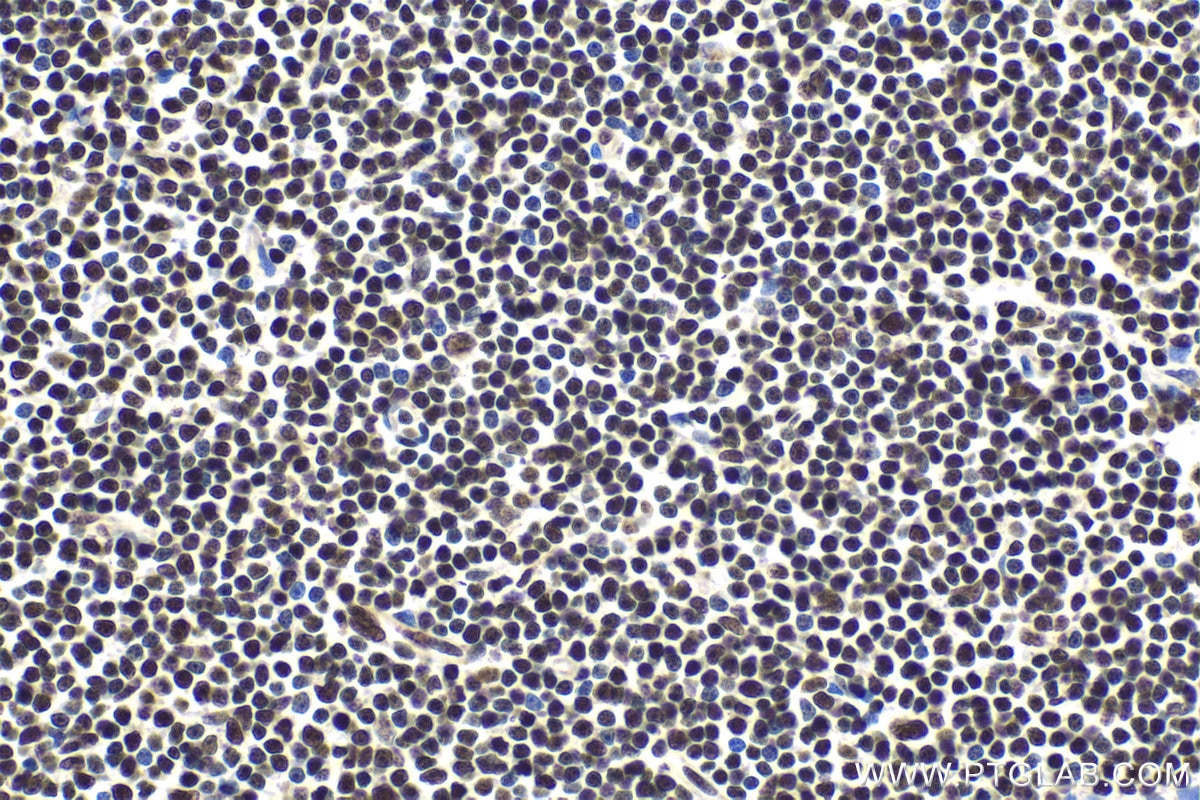 Immunohistochemical analysis of paraffin-embedded human lymphoma tissue slide using KHC1884 (KCTD15 IHC Kit).