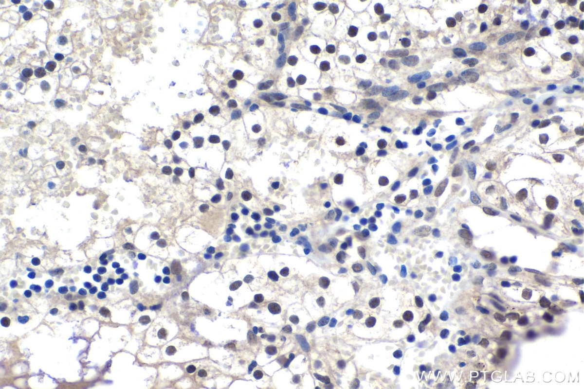 Immunohistochemical analysis of paraffin-embedded human renal cell carcinoma tissue slide using KHC1465 (KDM1 IHC Kit).