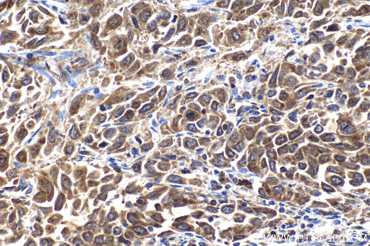 Immunohistochemical analysis of paraffin-embedded human cervical cancer tissue slide using KHC2023 (KDM3A IHC Kit).