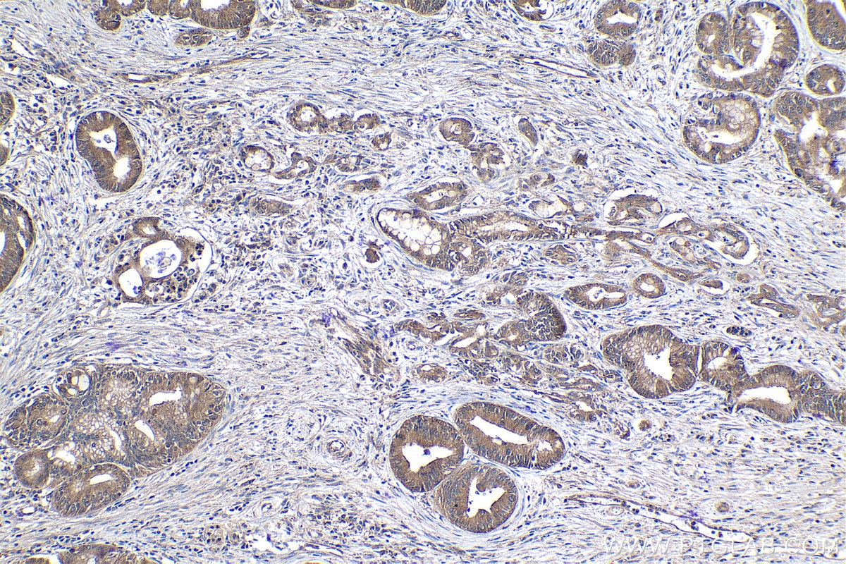 Immunohistochemical analysis of paraffin-embedded human pancreas cancer tissue slide using KHC1064 (KEAP1 IHC Kit).
