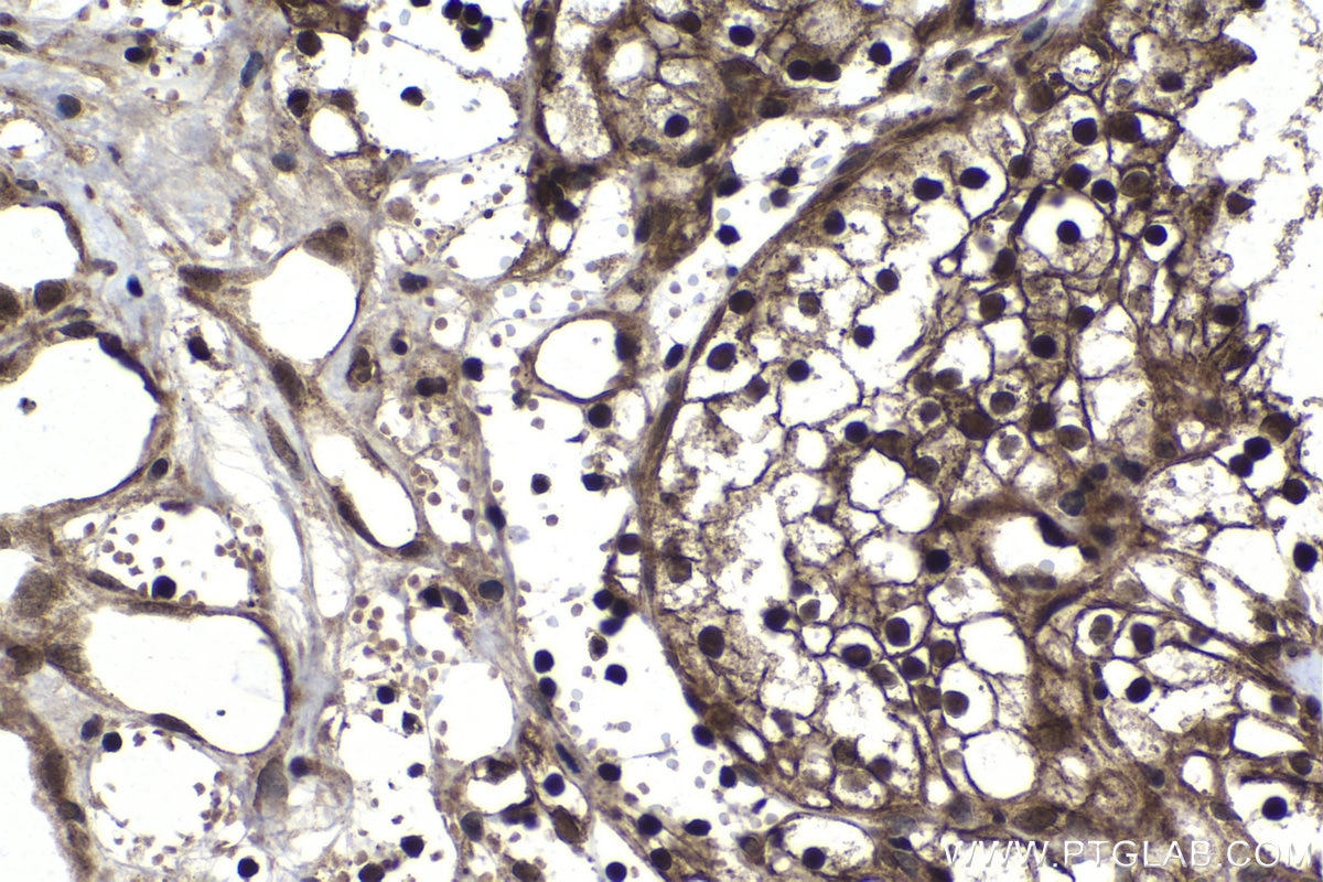 Immunohistochemical analysis of paraffin-embedded human renal cell carcinoma tissue slide using KHC1064 (KEAP1 IHC Kit).