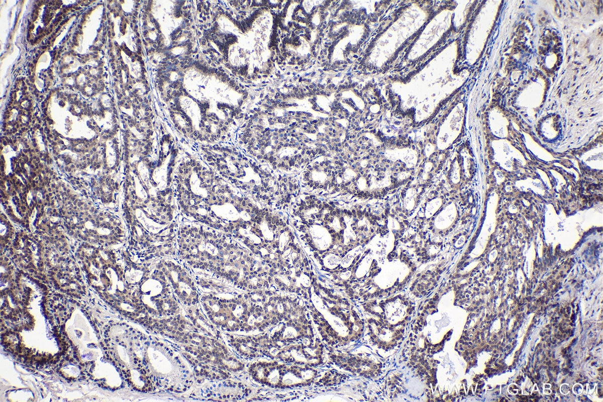 Immunohistochemical analysis of paraffin-embedded human breast cancer tissue slide using KHC1391 (KHDRBS1 IHC Kit).