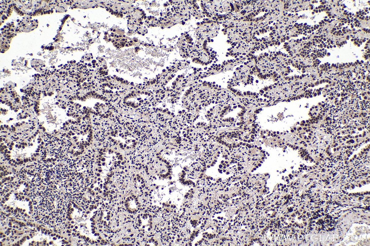 Immunohistochemical analysis of paraffin-embedded human lung cancer tissue slide using KHC1391 (KHDRBS1 IHC Kit).