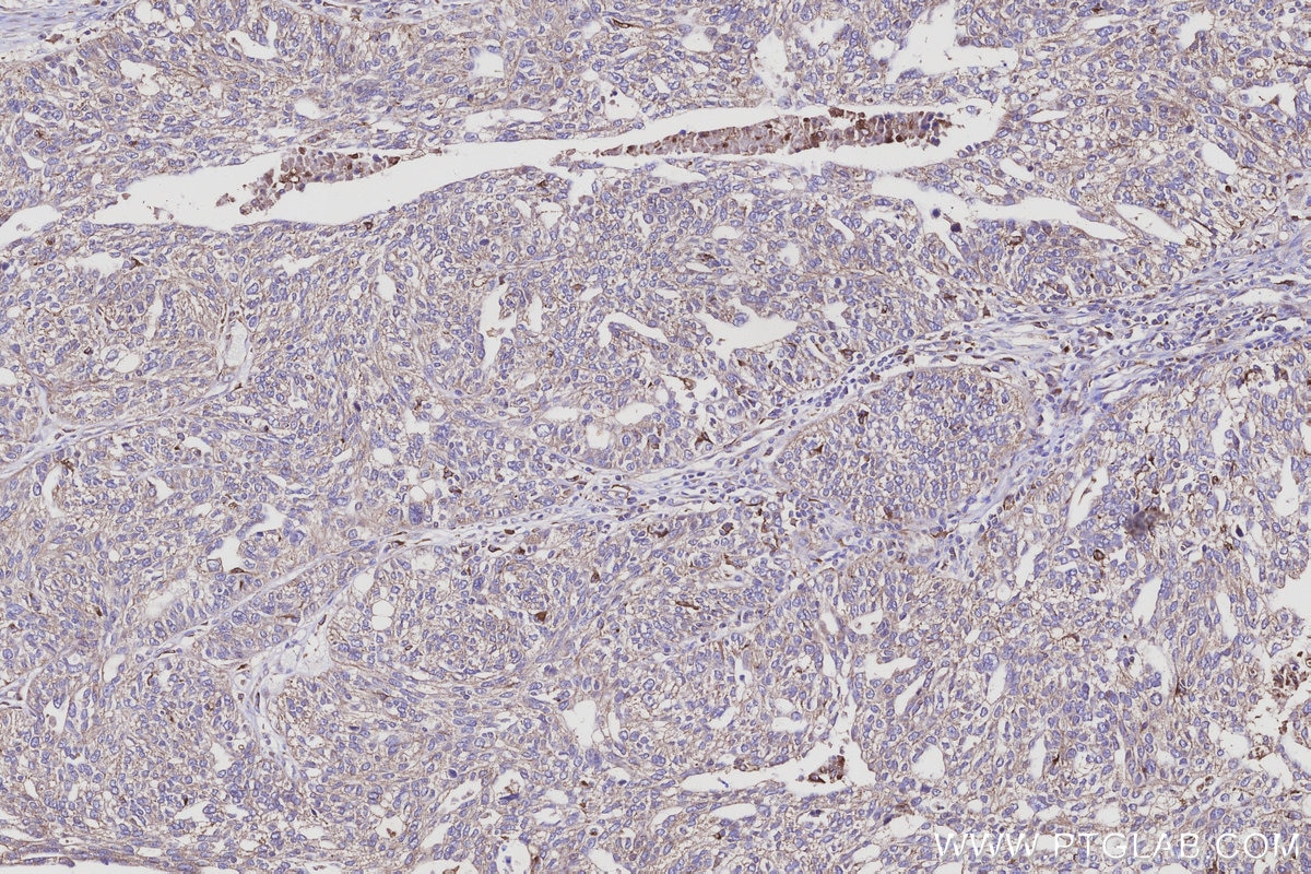 Immunohistochemical analysis of paraffin-embedded human ovary cancer tissue slide using KHC3119 (KIAA1468 IHC Kit). Immunohistochemical analysis of paraffin-embedded human ovary cancer tissue slide using KHC3119 (KIAA1468 IHC Kit).