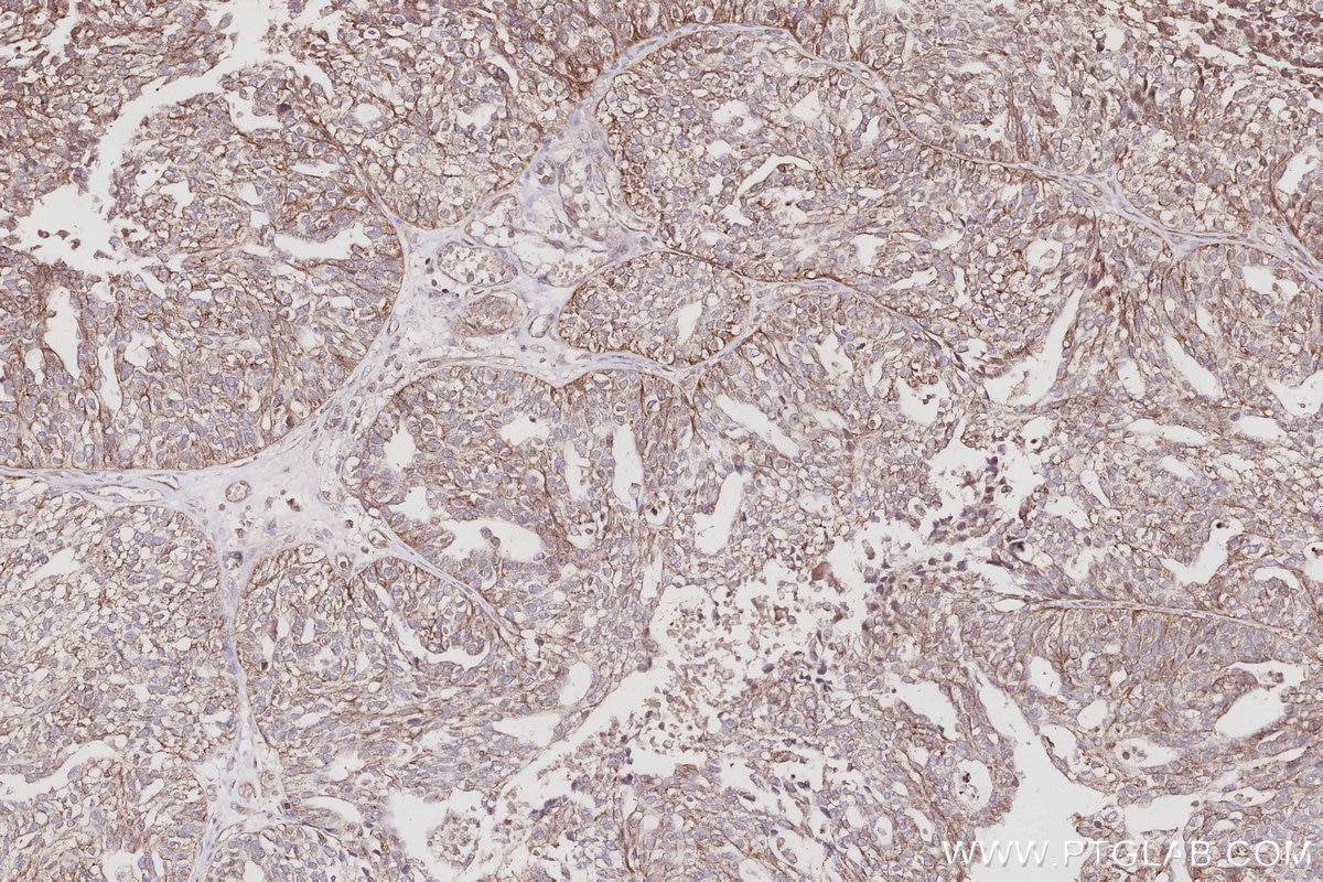 Immunohistochemical analysis of paraffin-embedded human ovary cancer tissue slide using KHC3036 (KIDINS220 IHC Kit). Immunohistochemical analysis of paraffin-embedded human ovary cancer tissue slide using KHC3036 (KIDINS220 IHC Kit).