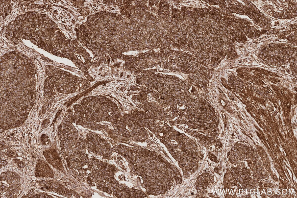 Immunohistochemical analysis of paraffin-embedded human stomach cancer tissue slide using KHC2903 (KIF13A IHC Kit).
