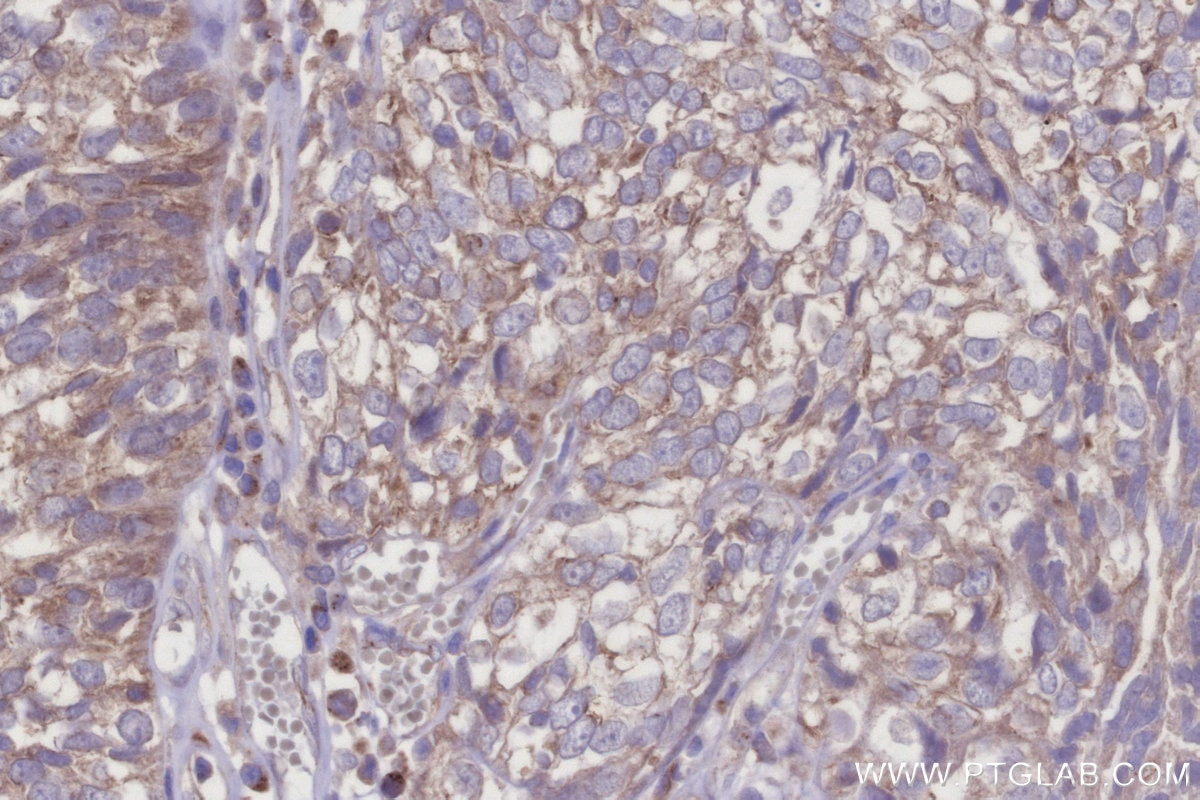 Immunohistochemical analysis of paraffin-embedded human ovary cancer tissue slide using KHC2951 (KIF15 IHC Kit).