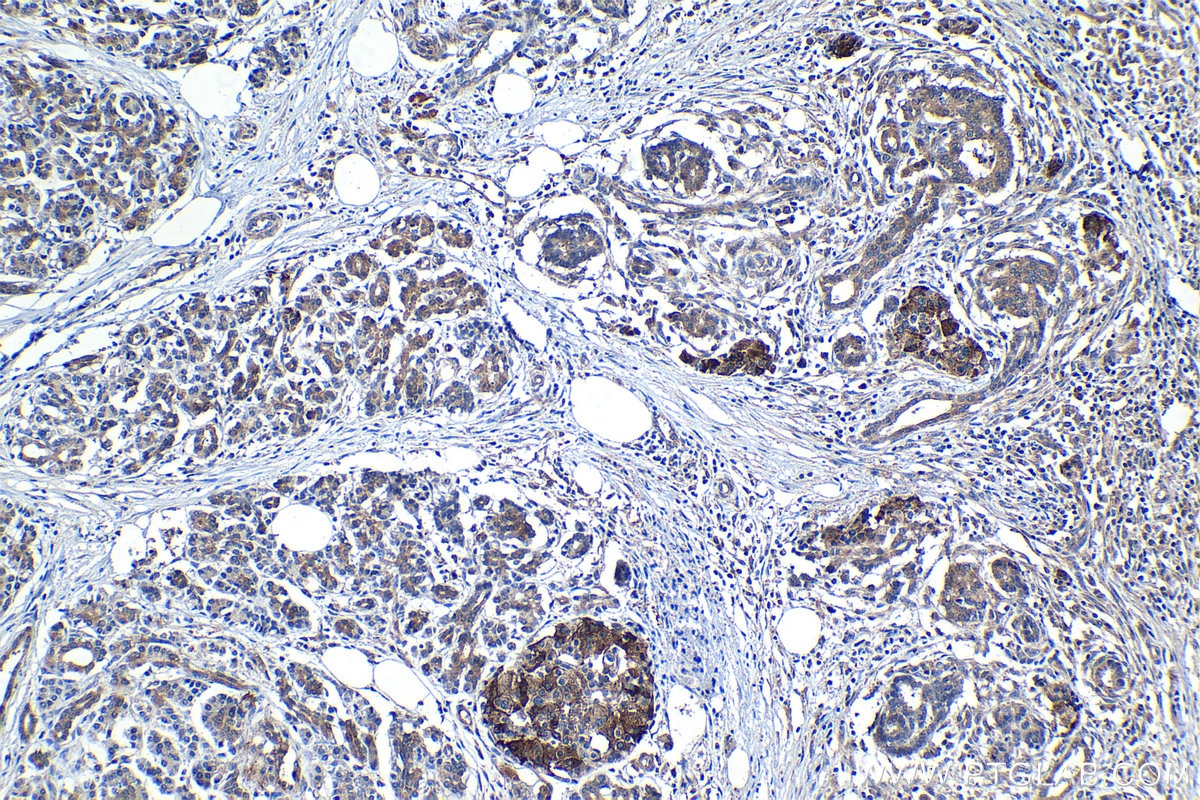 Immunohistochemical analysis of paraffin-embedded human pancreas cancer tissue slide using KHC1223 (KIF18A IHC Kit).