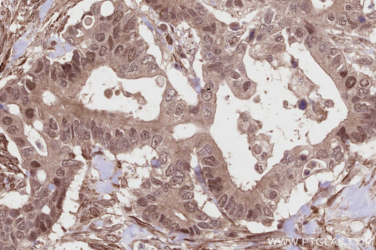 Immunohistochemical analysis of paraffin-embedded human rectal cancer tissue slide using KHC2820 (KIF20B IHC Kit).