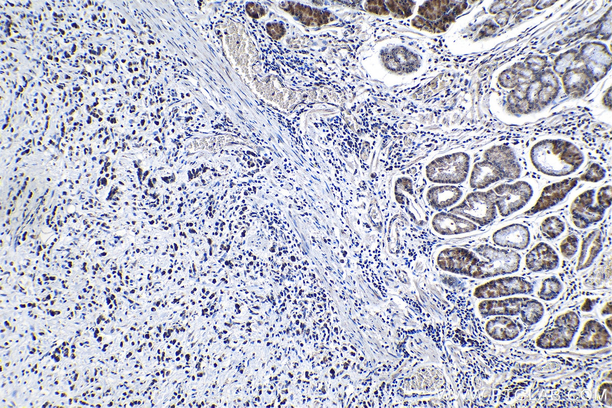 Immunohistochemical analysis of paraffin-embedded human stomach cancer tissue slide using KHC1255 (KIF22 IHC Kit).