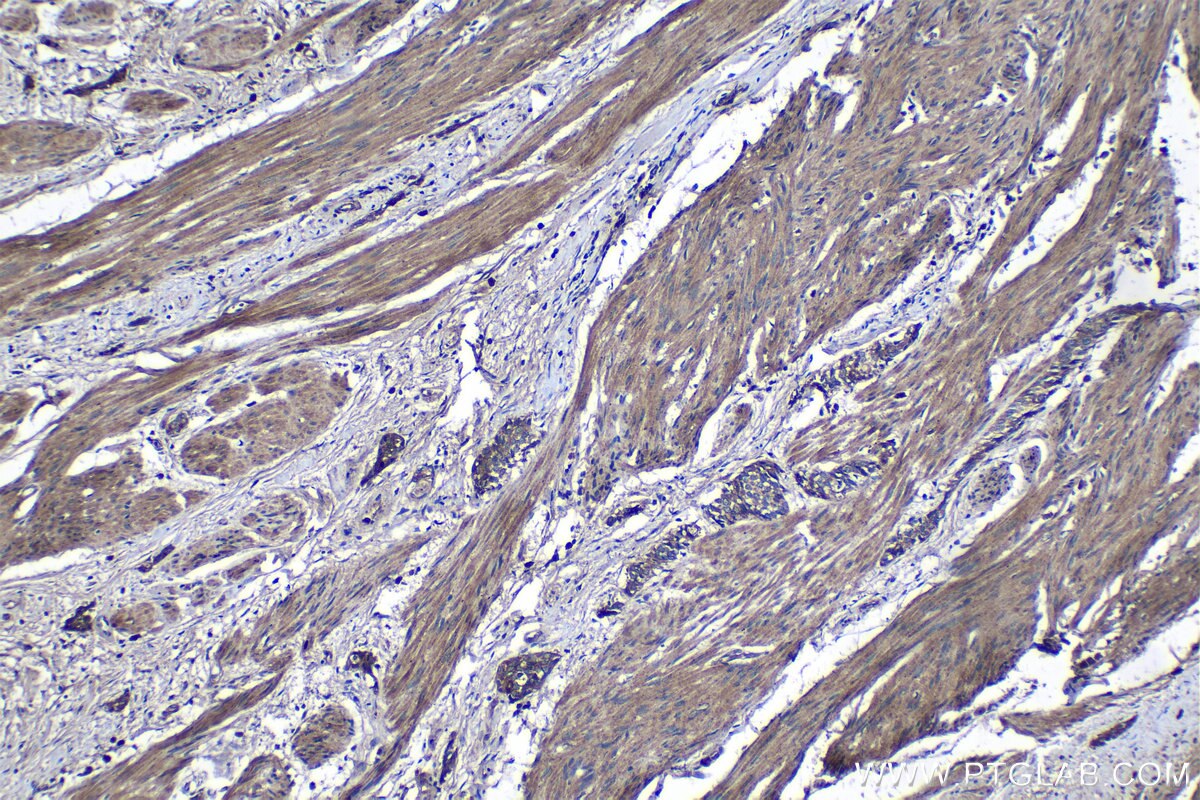 Immunohistochemical analysis of paraffin-embedded human urothelial carcinoma tissue slide using KHC1268 (KIF26B IHC Kit).