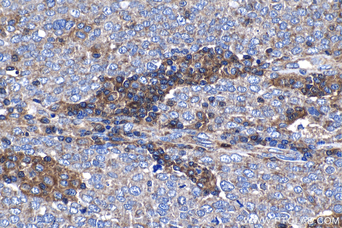 Immunohistochemical analysis of paraffin-embedded human ovary tumor tissue slide using KHC1268 (KIF26B IHC Kit).
