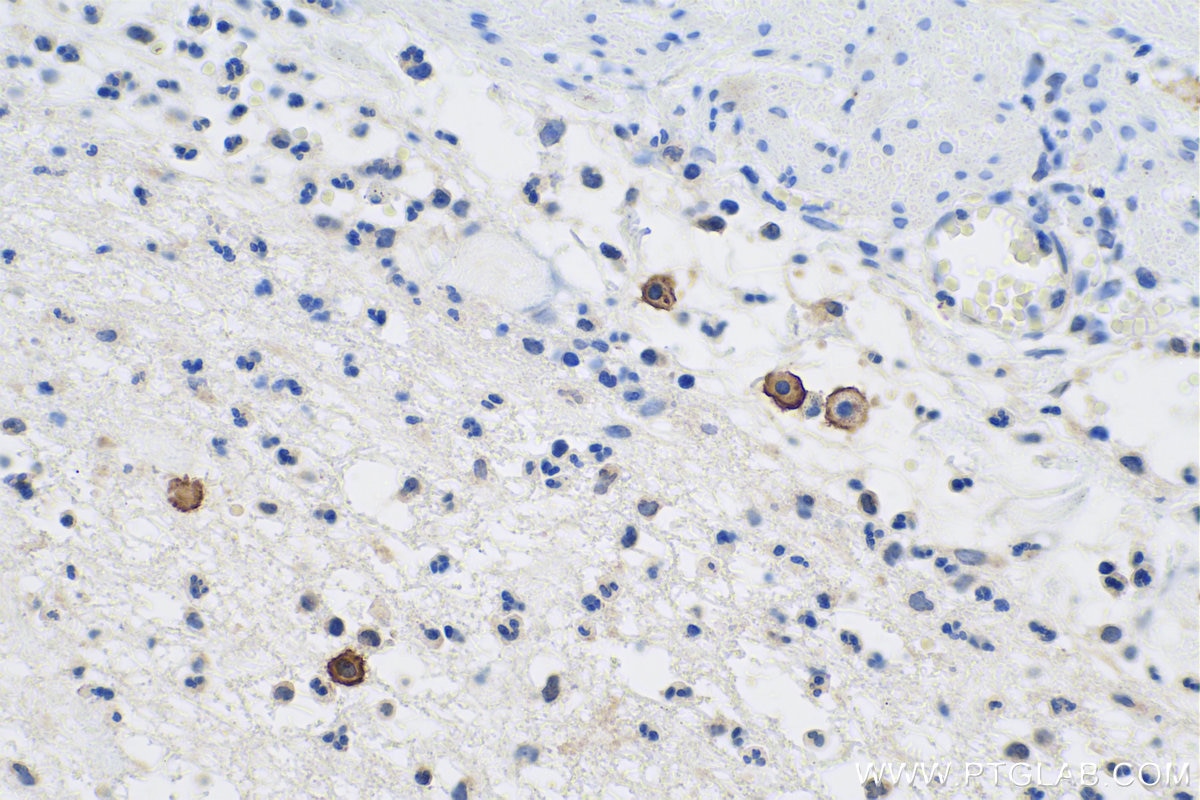 Immunohistochemical analysis of paraffin-embedded human appendicitis tissue slide using KHC0818 (KIT/CD117 IHC Kit).