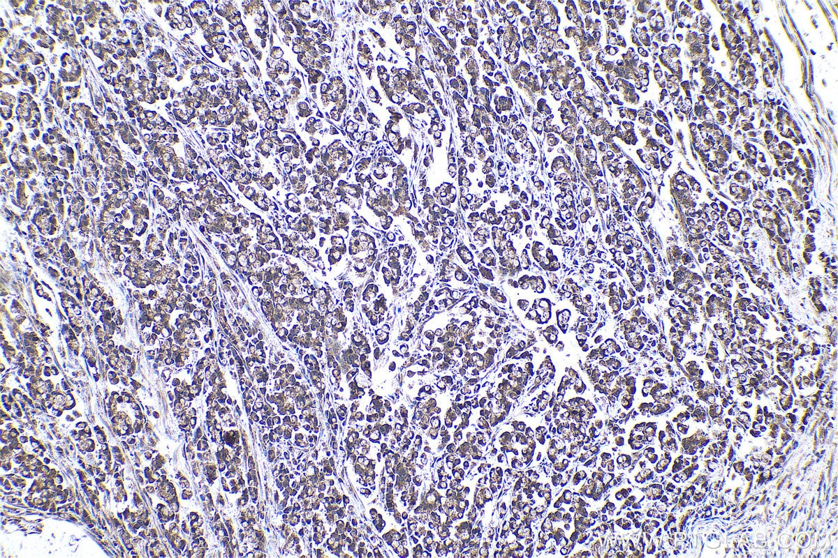 Immunohistochemical analysis of paraffin-embedded human colon cancer tissue slide using KHC0963 (KLC2 IHC Kit).