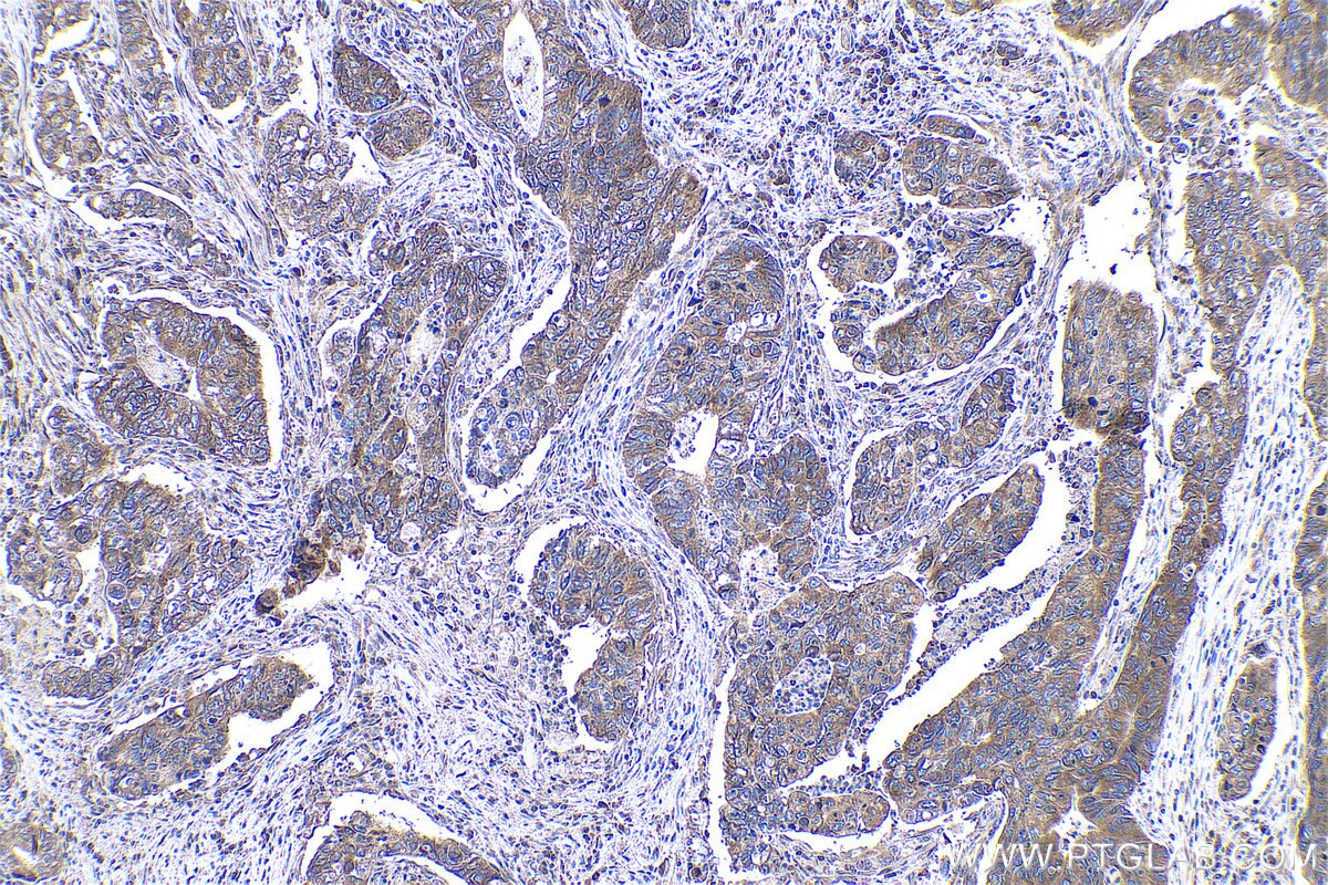Immunohistochemical analysis of paraffin-embedded human stomach cancer tissue slide using KHC0963 (KLC2 IHC Kit).