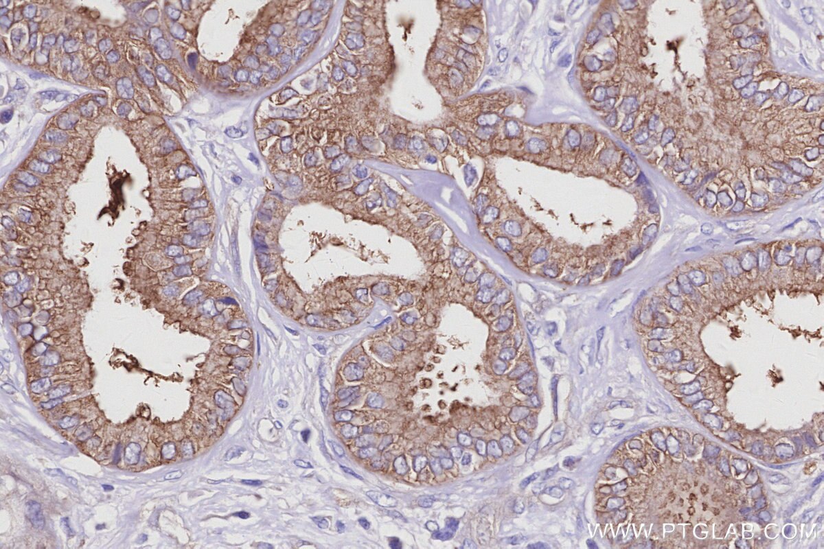 Immunohistochemical analysis of paraffin-embedded human pancreas cancer tissue slide using KHC2953 (KLC4 IHC Kit).