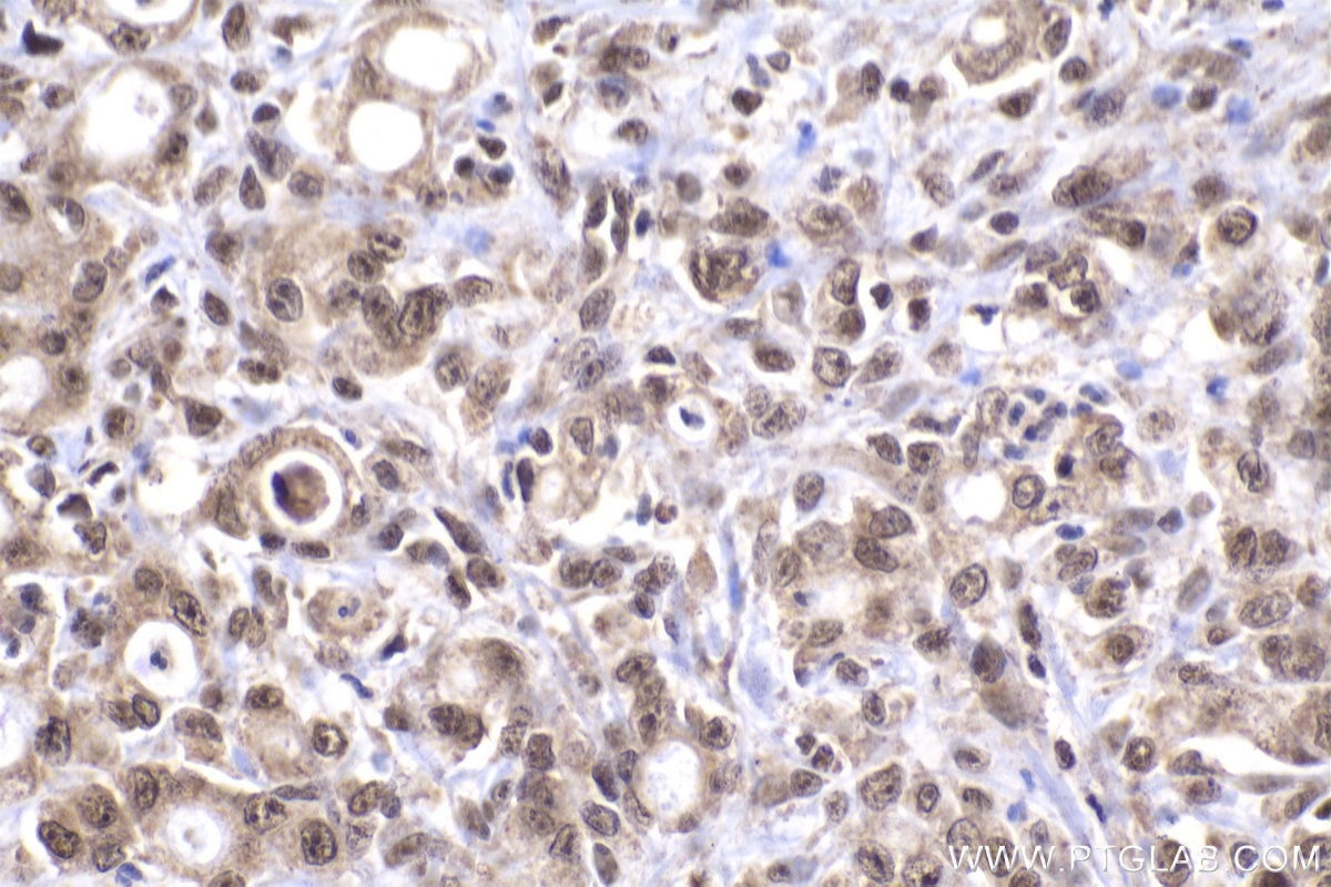 Immunohistochemical analysis of paraffin-embedded human stomach cancer tissue slide using KHC2019 (KLF13 IHC Kit).