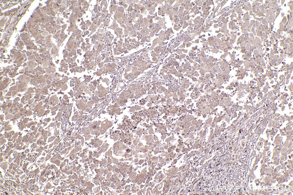 Immunohistochemical analysis of paraffin-embedded human lung cancer tissue slide using KHC2535 (KLHL22 IHC Kit).