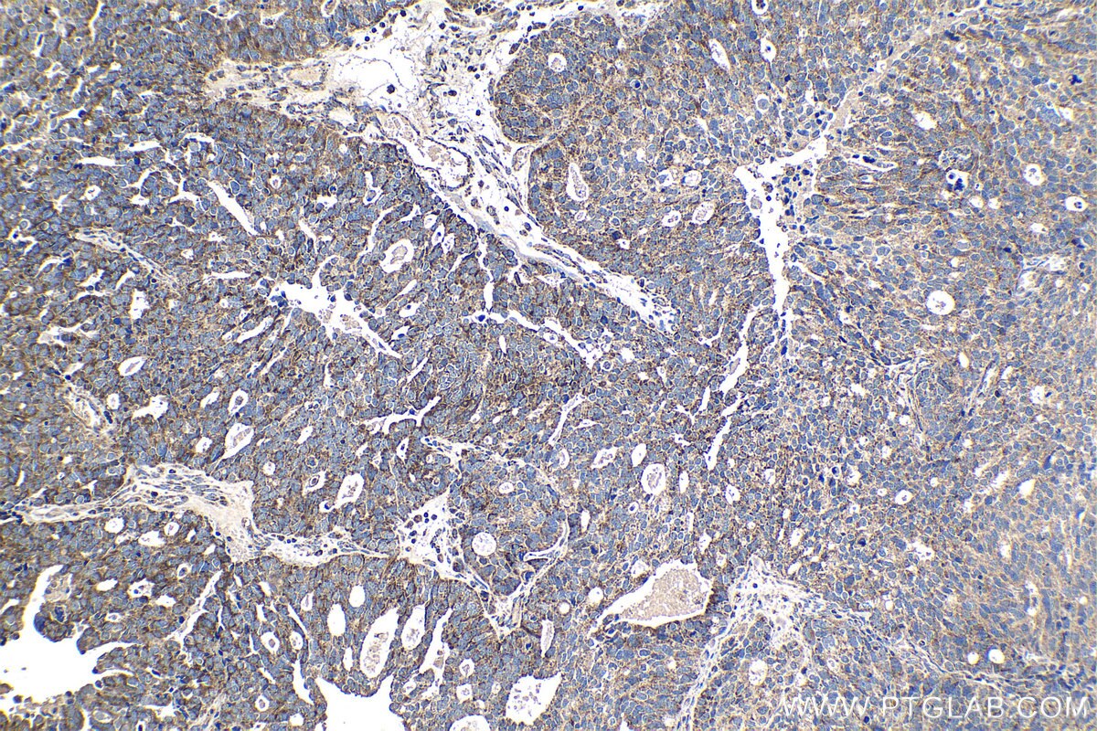 Immunohistochemical analysis of paraffin-embedded human ovary tumor tissue slide using KHC1110 (KLK11 IHC Kit).