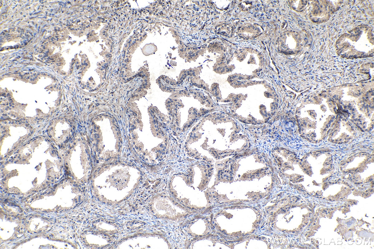Immunohistochemical analysis of paraffin-embedded human prostate cancer tissue slide using KHC1110 (KLK11 IHC Kit).