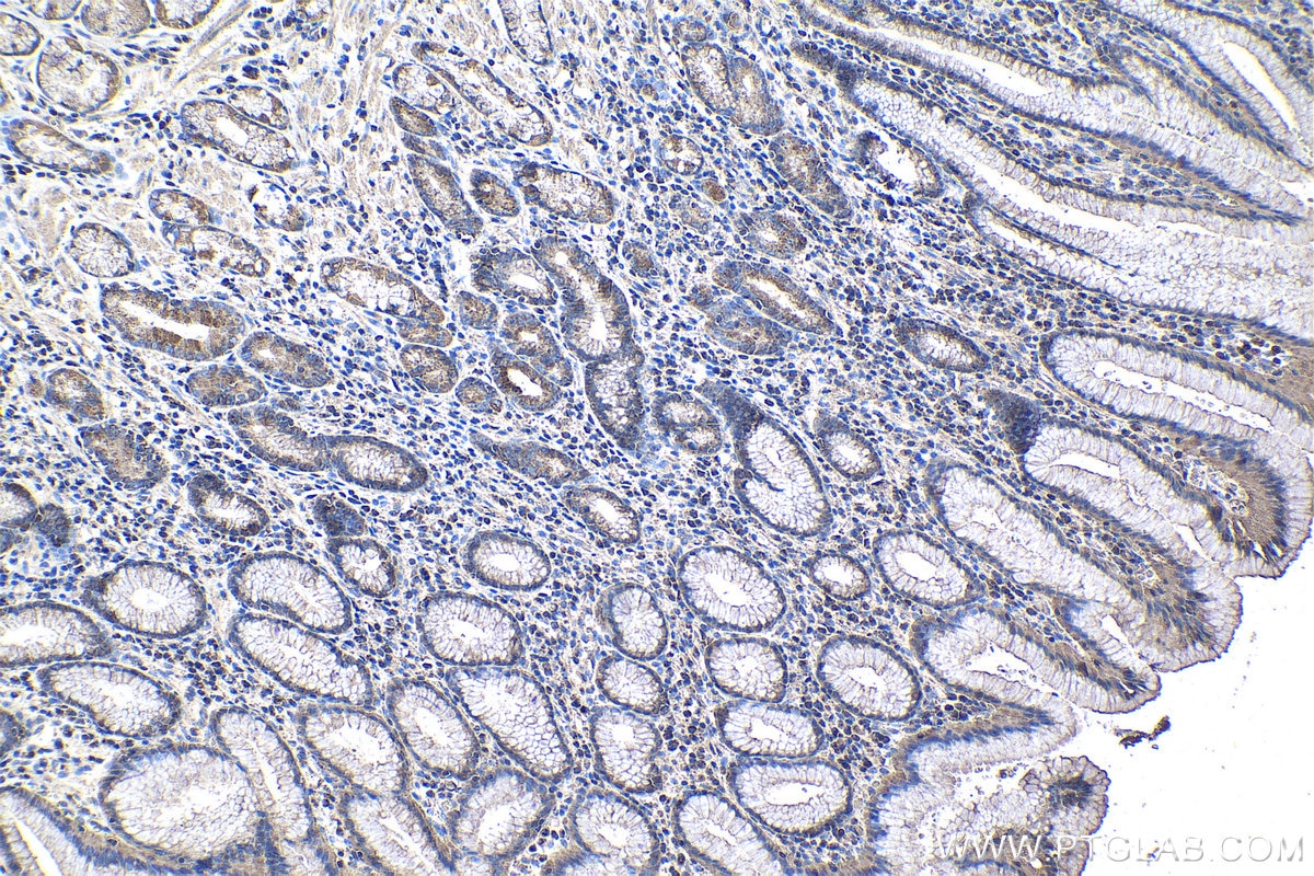 Immunohistochemical analysis of paraffin-embedded human stomach cancer tissue slide using KHC1110 (KLK11 IHC Kit).