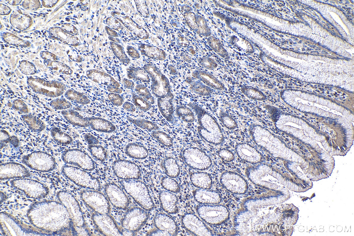 Immunohistochemical analysis of paraffin-embedded human stomach cancer tissue slide using KHC1110 (KLK11 IHC Kit).