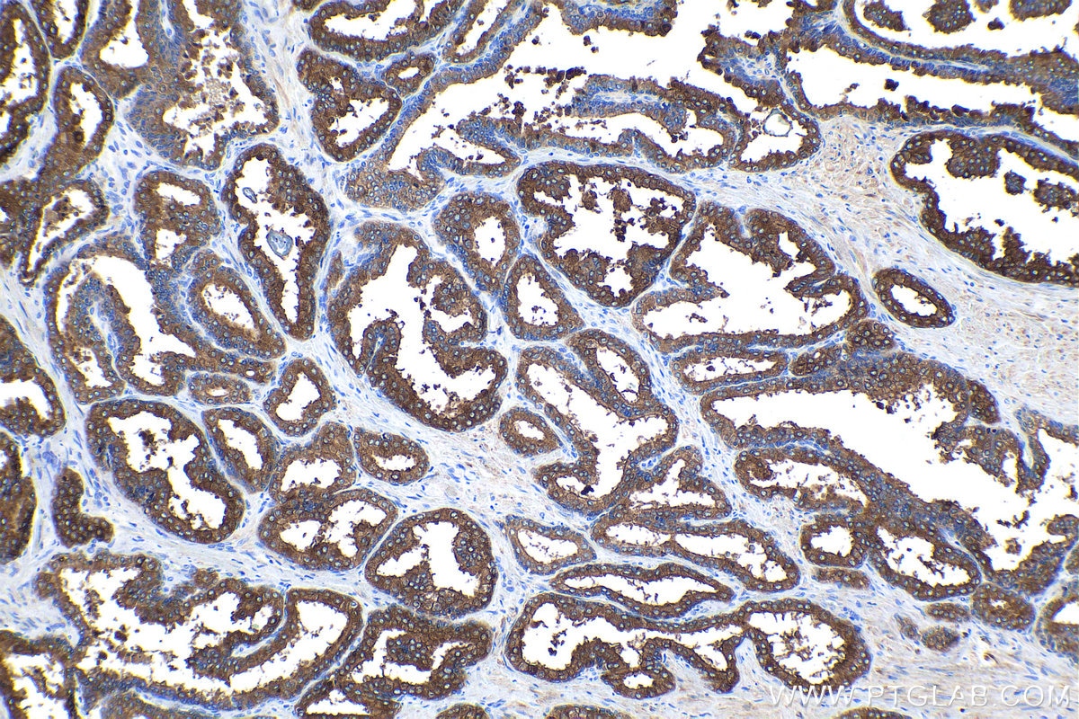Immunohistochemical analysis of paraffin-embedded human prostate hyperplasia tissue slide using KHC1104 (KLK2 IHC Kit).