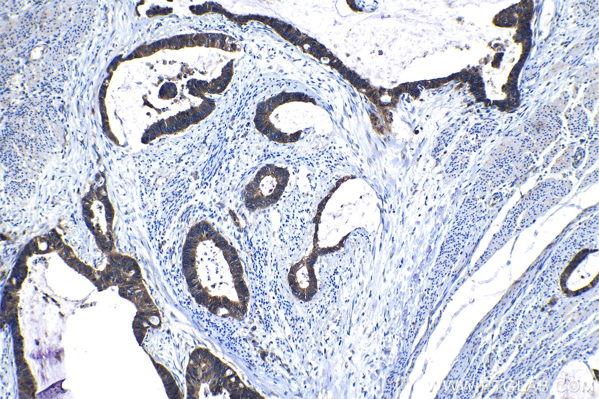 Immunohistochemical analysis of paraffin-embedded human urothelial carcinoma tissue slide using KHC1328 (KLK8 IHC Kit).