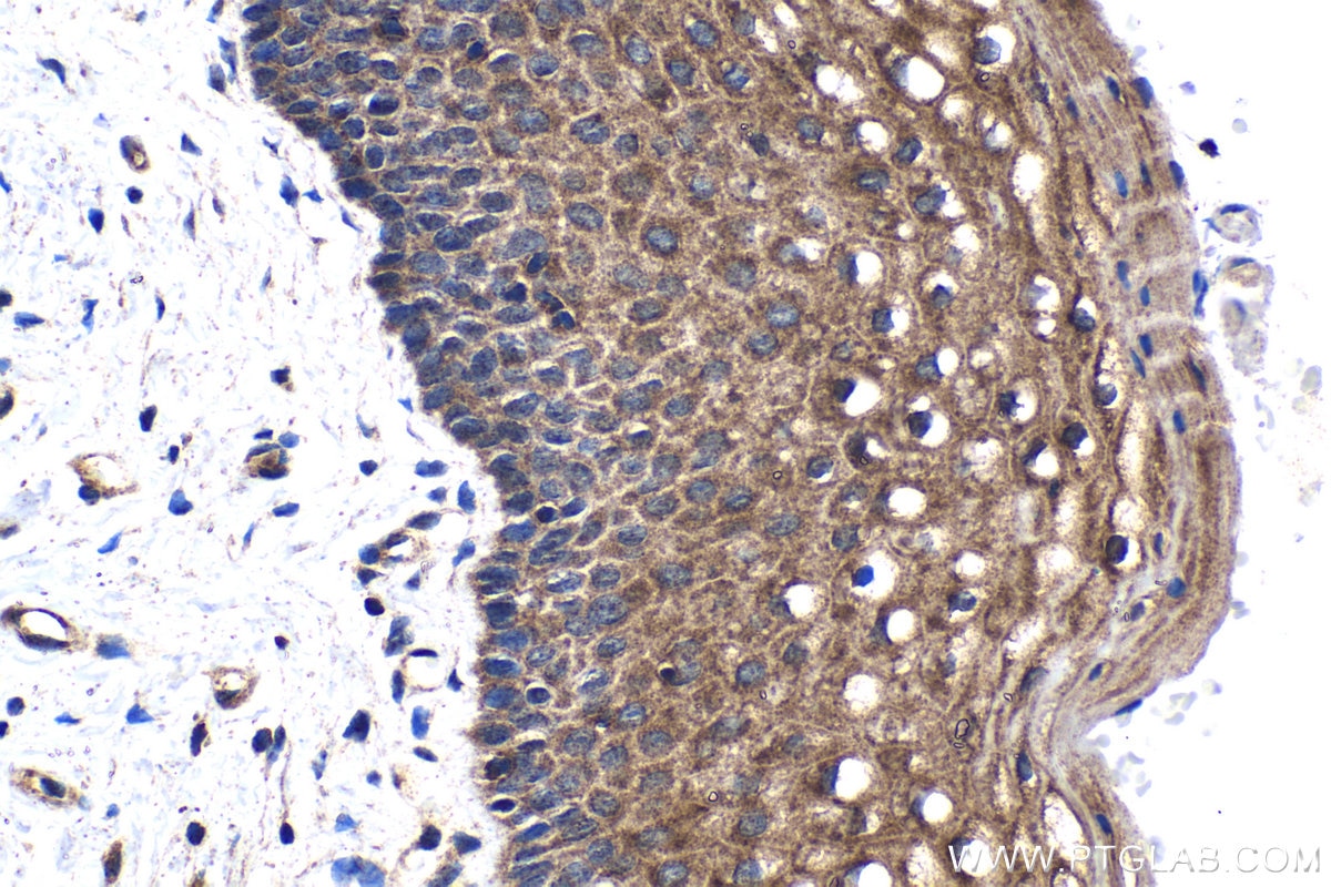 Immunohistochemical analysis of paraffin-embedded human cervical cancer tissue slide using KHC1328 (KLK8 IHC Kit).