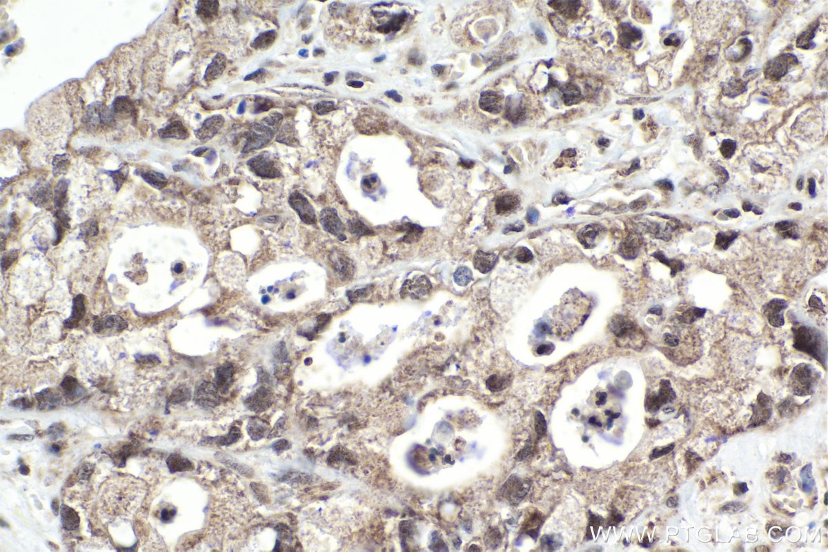 Immunohistochemical analysis of paraffin-embedded human pancreas cancer tissue slide using KHC1827 (KMT2E/MLL5 IHC Kit).