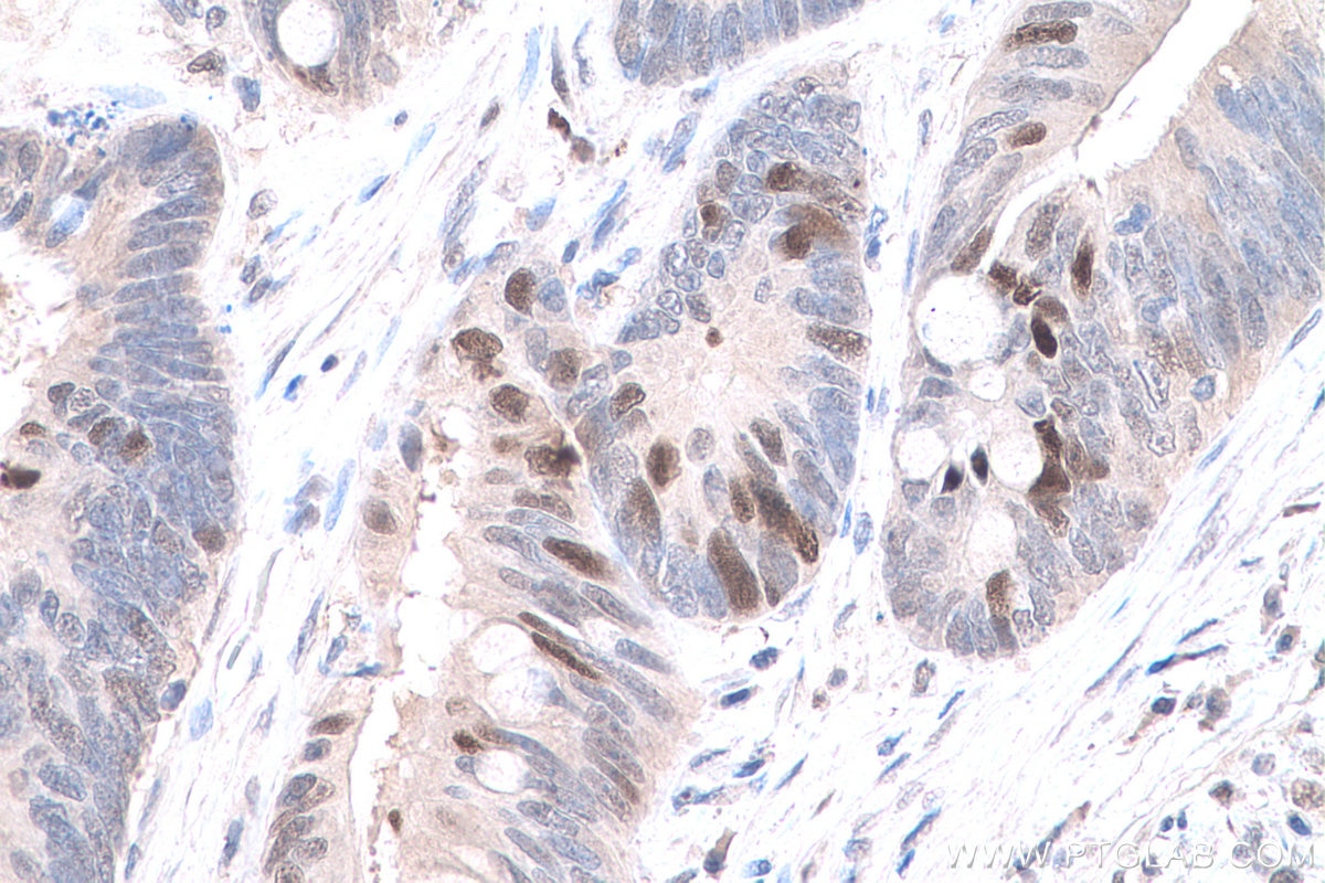 Immunohistochemical analysis of paraffin-embedded human colon cancer tissue slide using KHC0799 (KPNA2 IHC Kit).