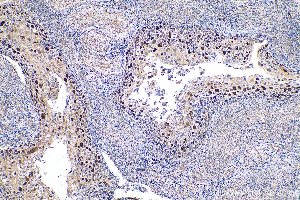Immunohistochemical analysis of paraffin-embedded human cervical cancer tissue slide using KHC0799 (KPNA2 IHC Kit).
