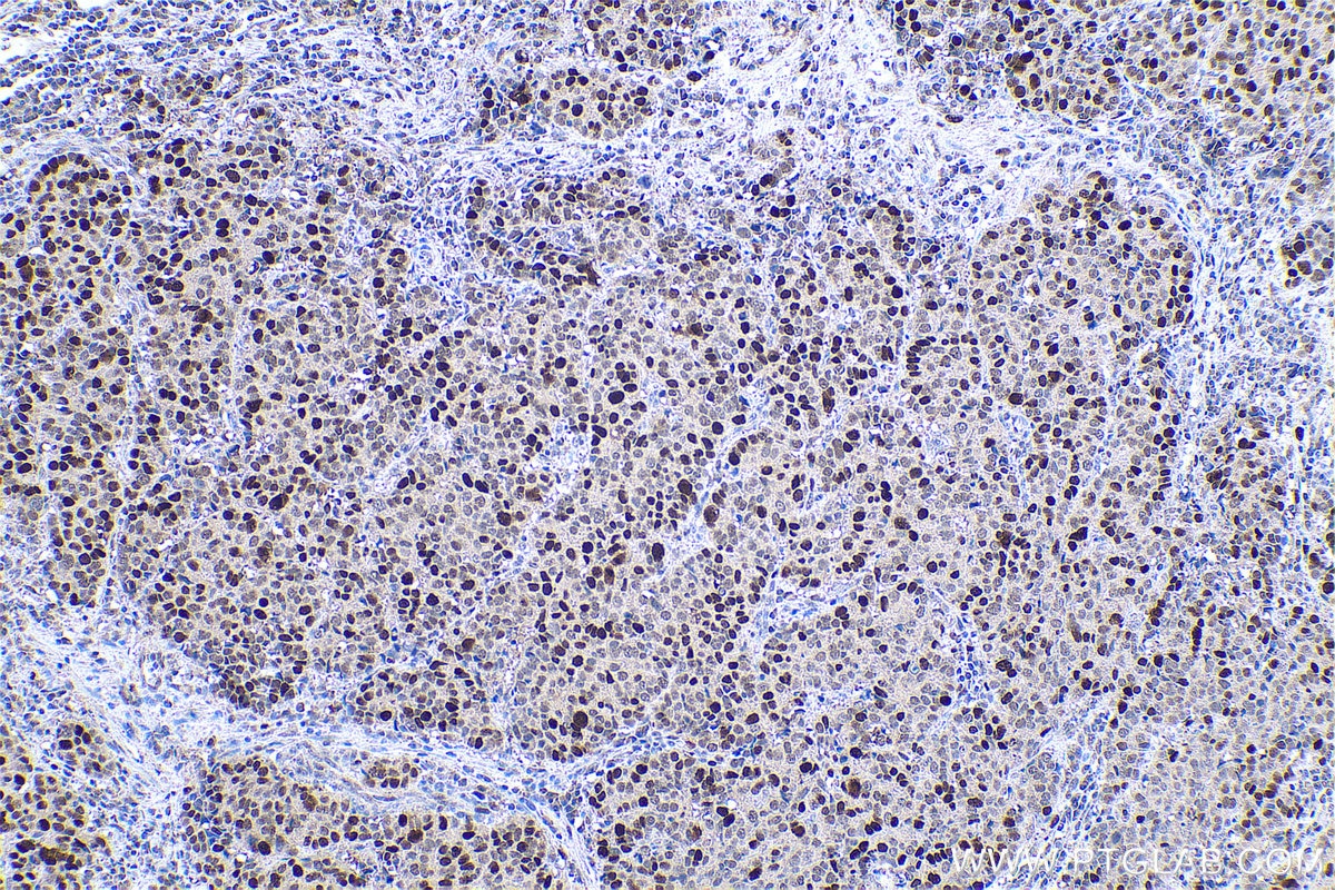Immunohistochemical analysis of paraffin-embedded human stomach cancer tissue slide using KHC0799 (KPNA2 IHC Kit).