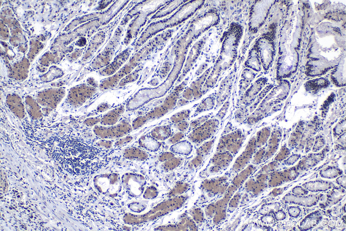 Immunohistochemical analysis of paraffin-embedded human stomach cancer tissue slide using KHC1242 (KPNA3 IHC Kit).