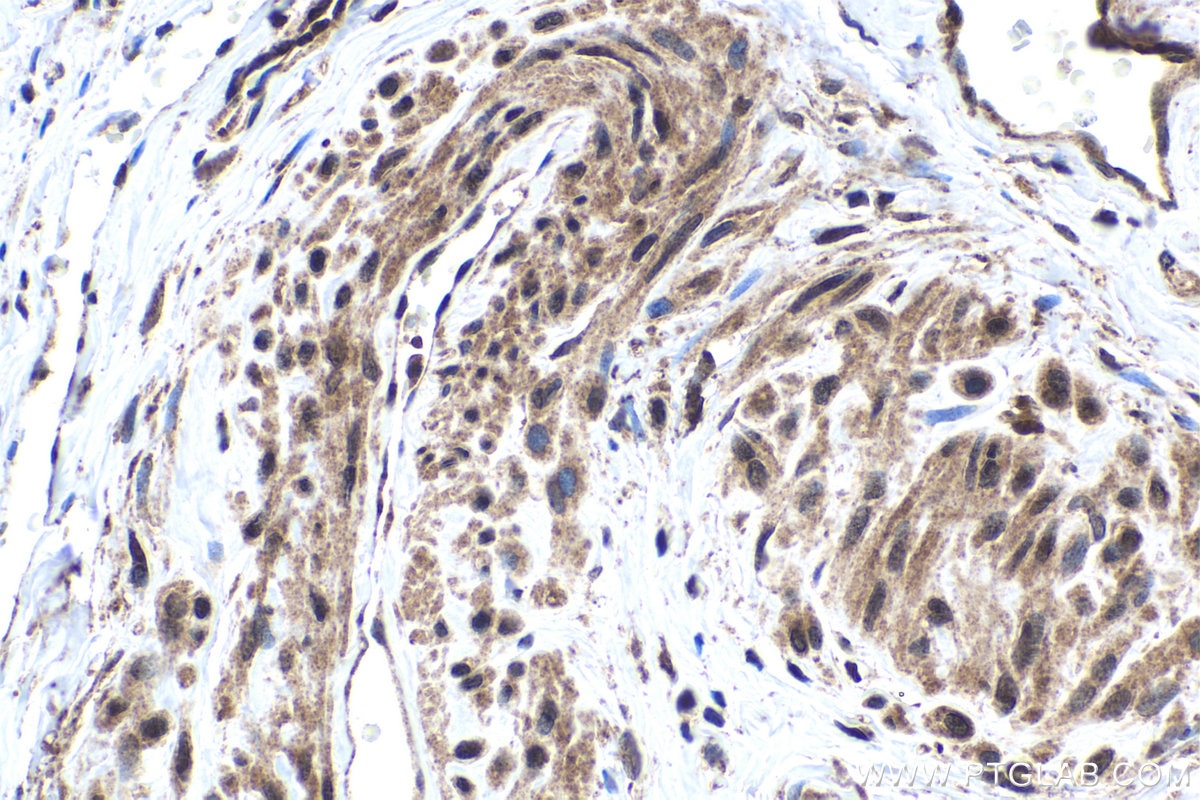 Immunohistochemical analysis of paraffin-embedded human cervical cancer tissue slide using KHC1742 (KPNB1 IHC Kit).