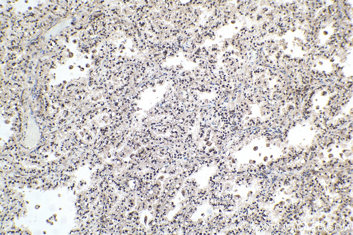 Immunohistochemical analysis of paraffin-embedded human lung cancer tissue slide using KHC1742 (KPNB1 IHC Kit).