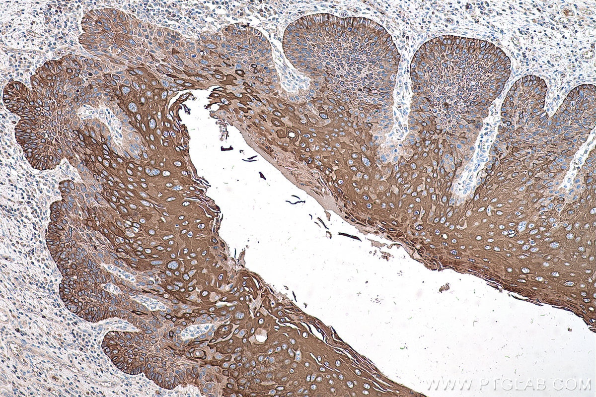 Immunohistochemical analysis of paraffin-embedded human oesophagus cancer tissue slide using KHC0582 (KRT10 IHC Kit).