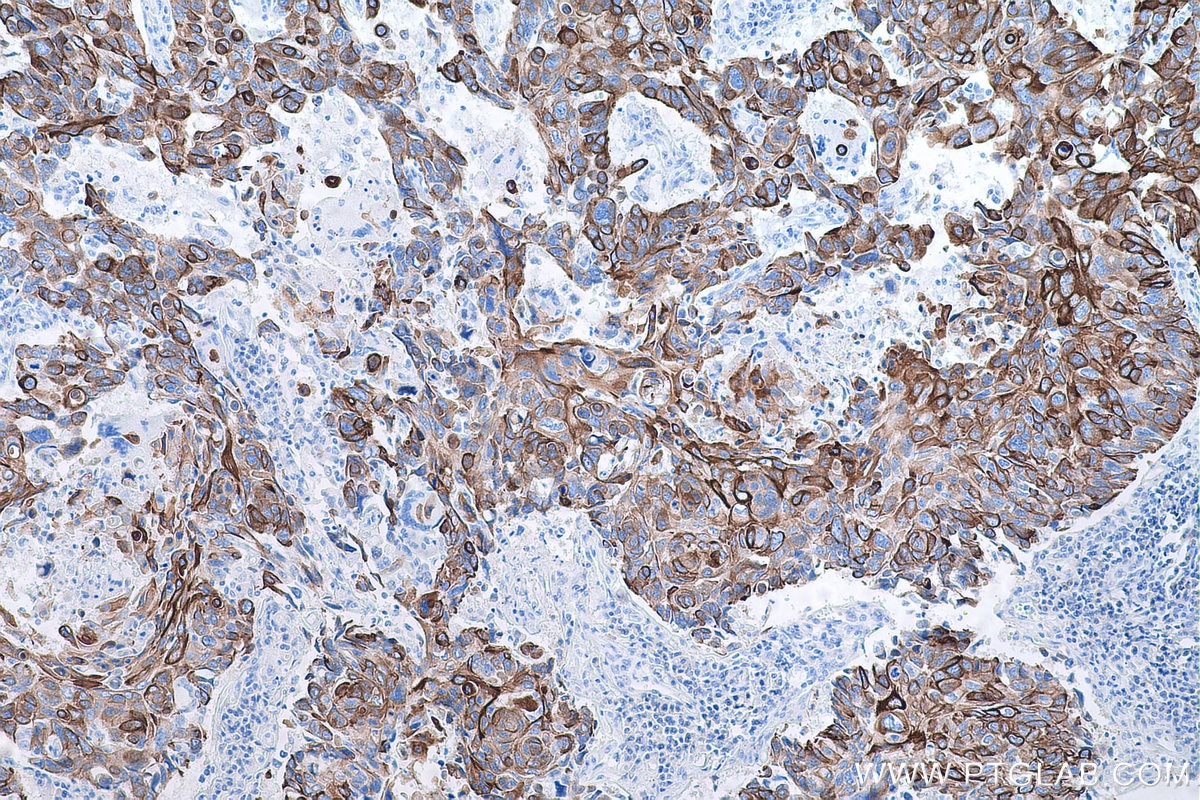 Immunohistochemical analysis of paraffin-embedded human lung cancer tissue slide using KHC0750 (KRT13 IHC Kit).