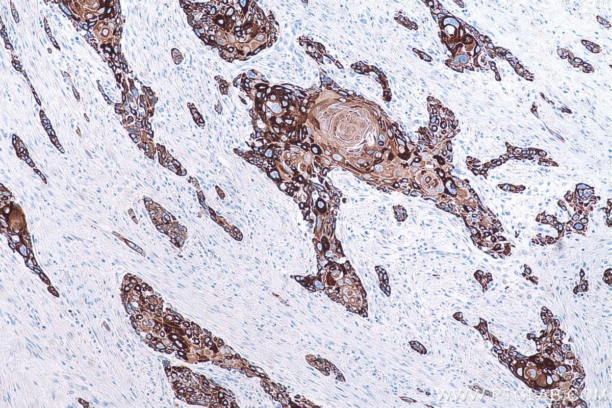 Immunohistochemical analysis of paraffin-embedded human oesophagus cancer tissue slide using KHC0750 (KRT13 IHC Kit).