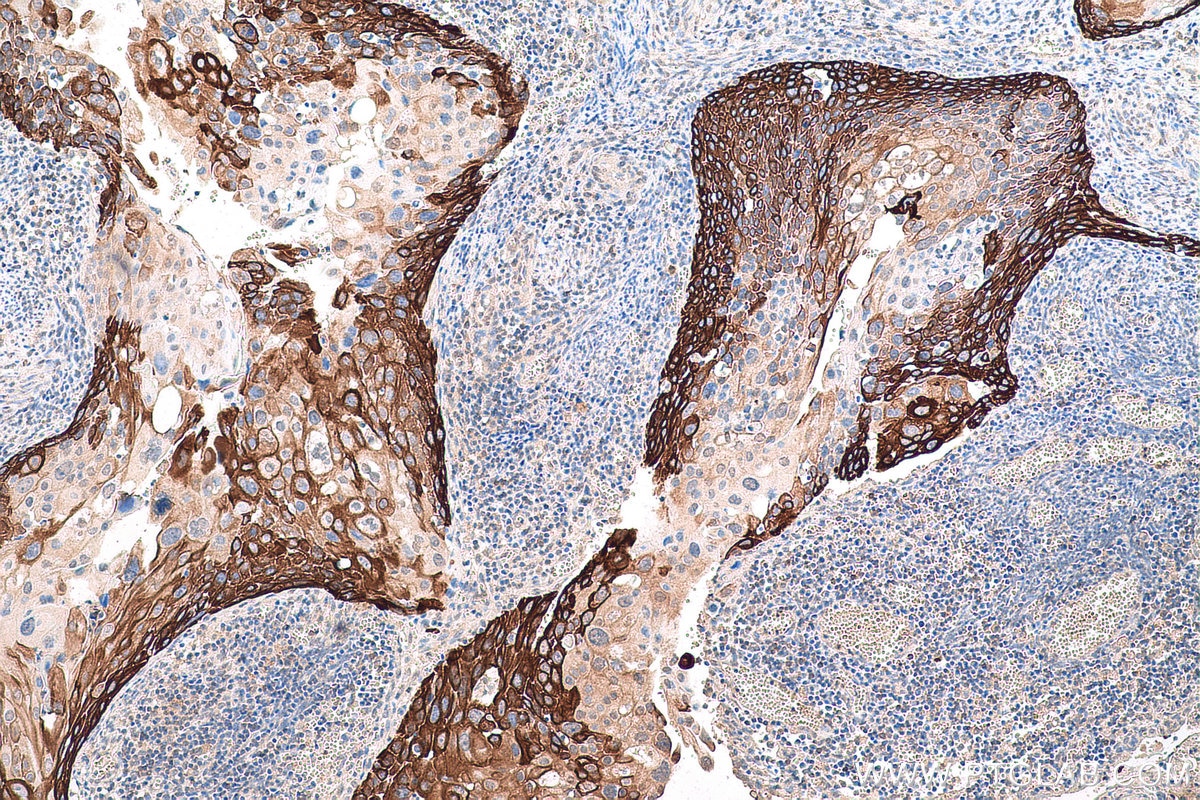 Immunohistochemical analysis of paraffin-embedded human cervical cancer tissue slide using KHC0751 (KRT14 IHC Kit).