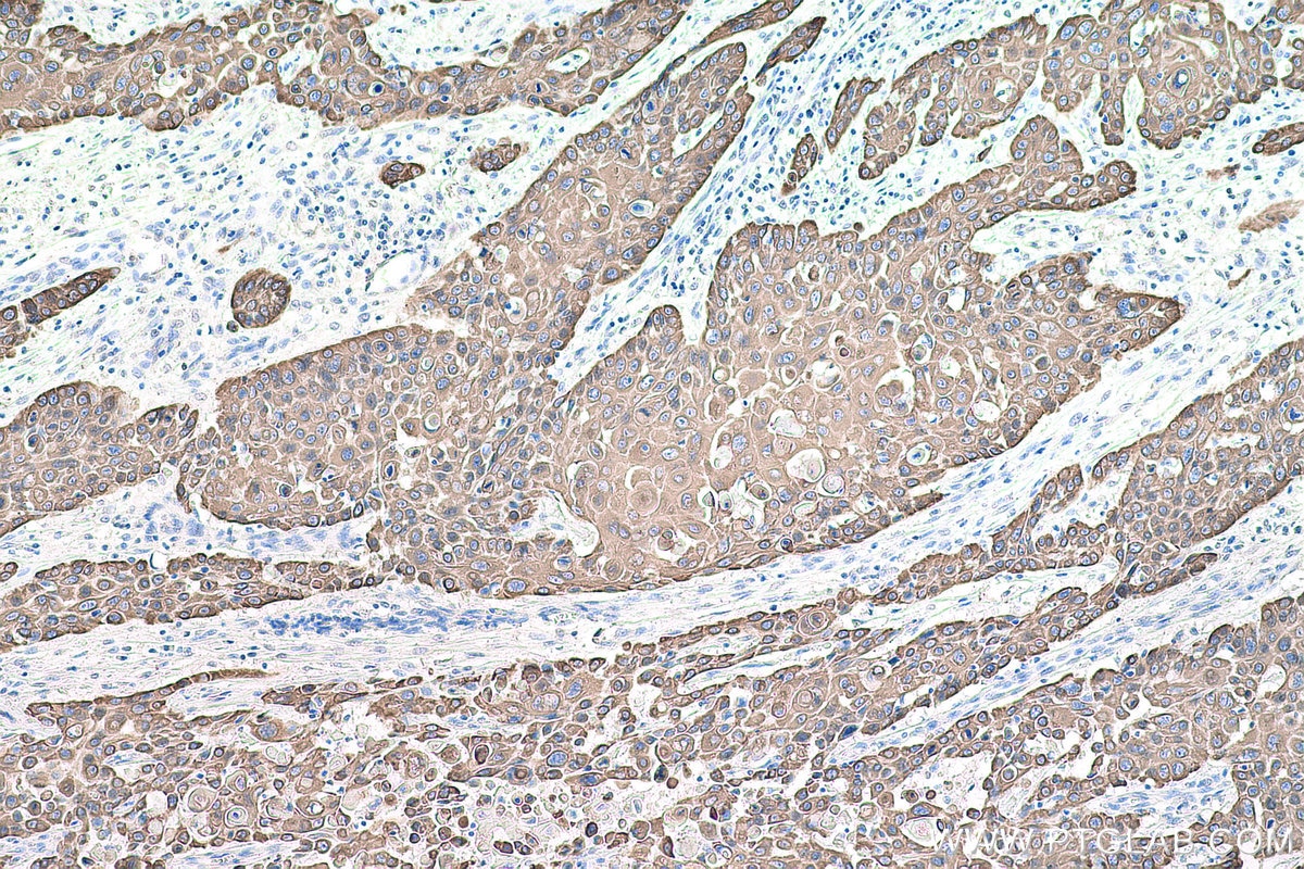 Immunohistochemical analysis of paraffin-embedded human oesophagus cancer tissue slide using KHC0751 (KRT14 IHC Kit).