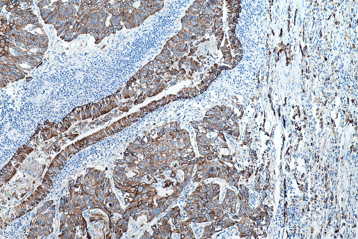 Immunohistochemical analysis of paraffin-embedded human lung cancer tissue slide using KHC0752 (KRT15 IHC Kit).