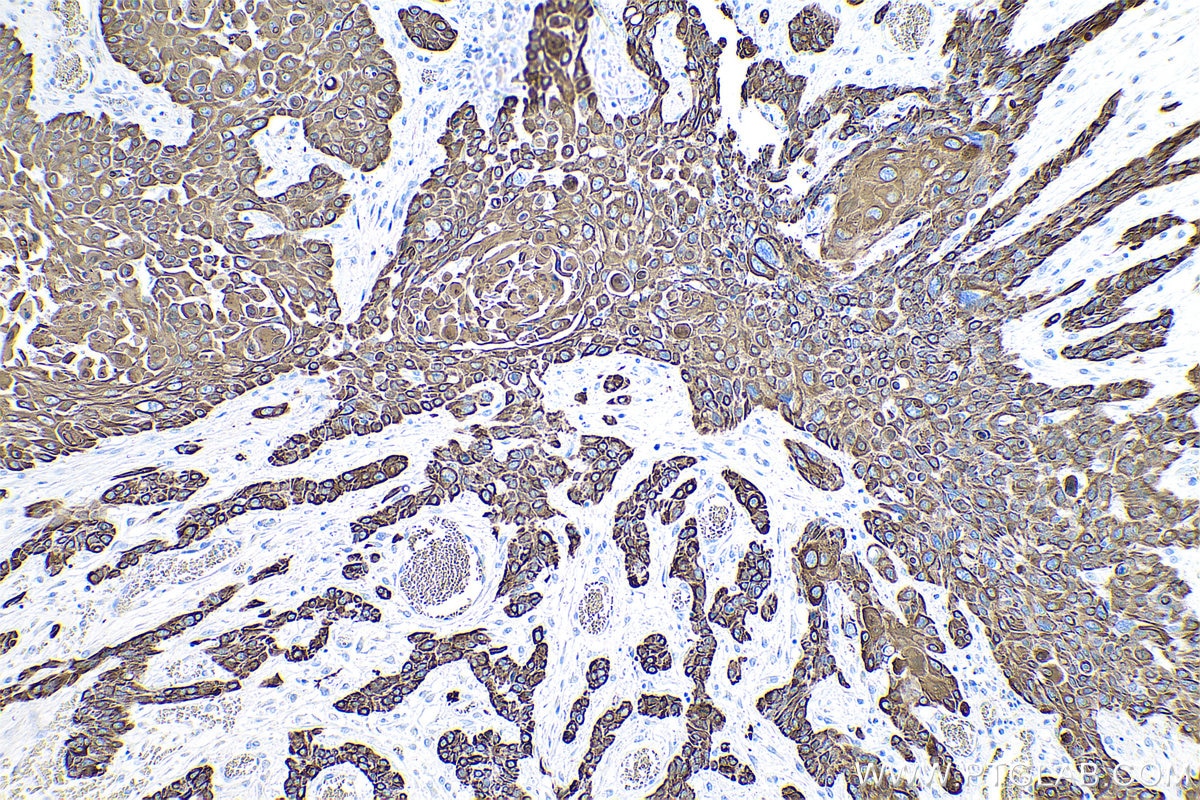 Immunohistochemical analysis of paraffin-embedded human oesophagus cancer tissue slide using KHC0752 (KRT15 IHC Kit).