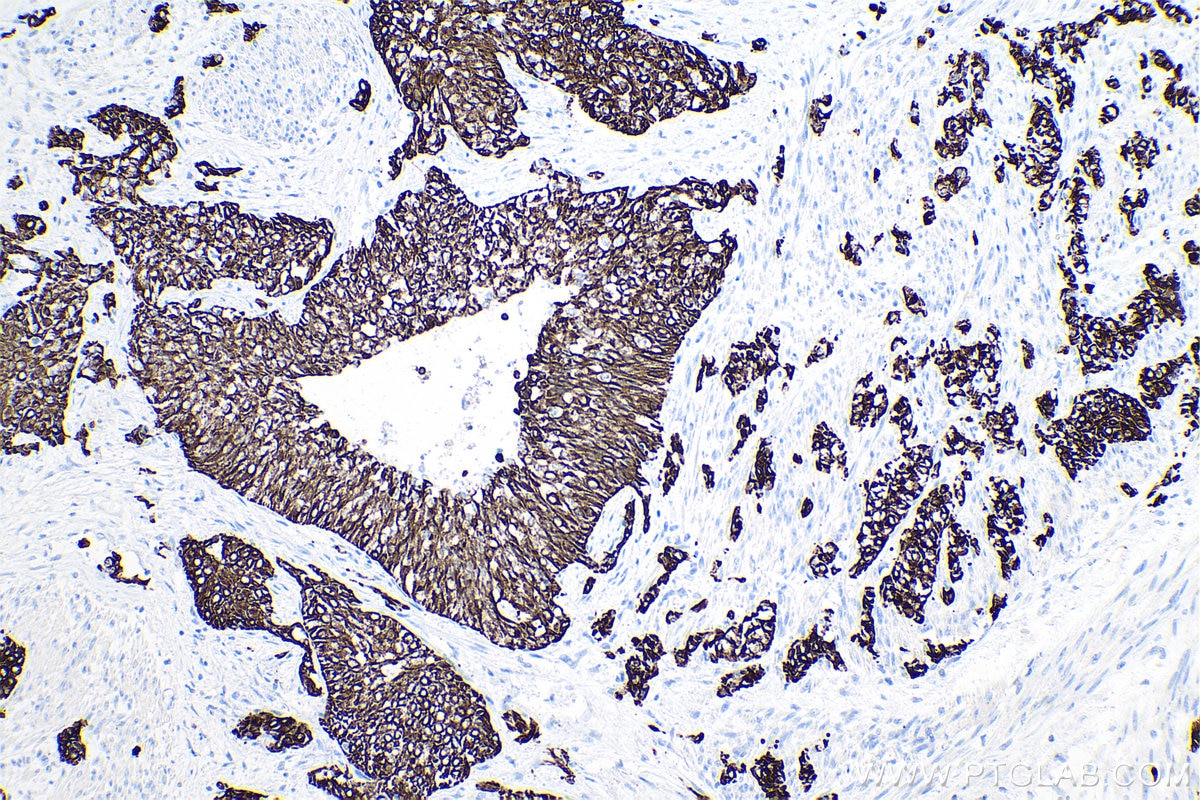 Immunohistochemical analysis of paraffin-embedded human urothelial carcinoma tissue slide using KHC0752 (KRT15 IHC Kit).