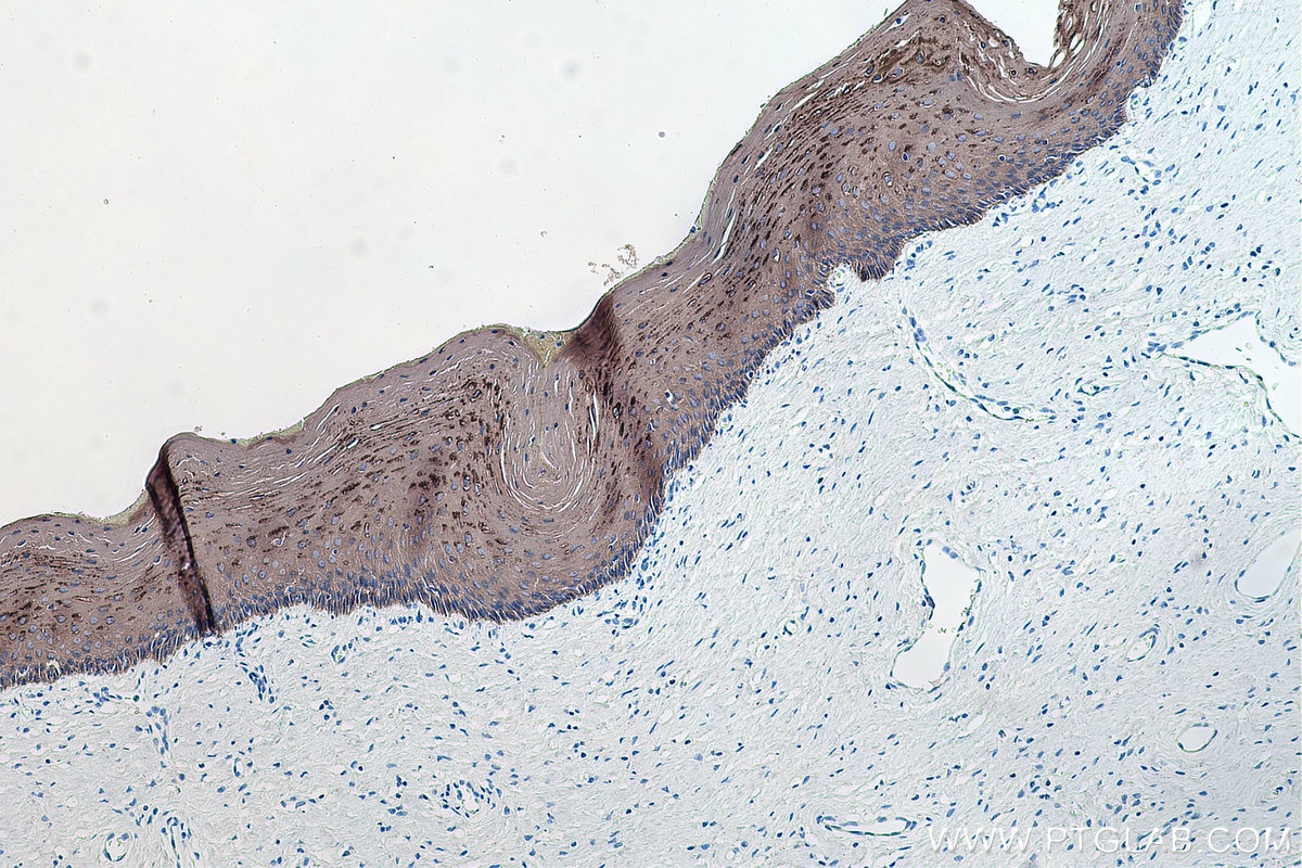 Immunohistochemical analysis of paraffin-embedded human cervical cancer tissue slide using KHC0142 (Cytokeratin 16 IHC Kit).