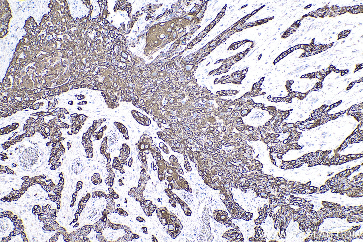 Immunohistochemical analysis of paraffin-embedded human oesophagus cancer tissue slide using KHC0753 (KRT17 IHC Kit).