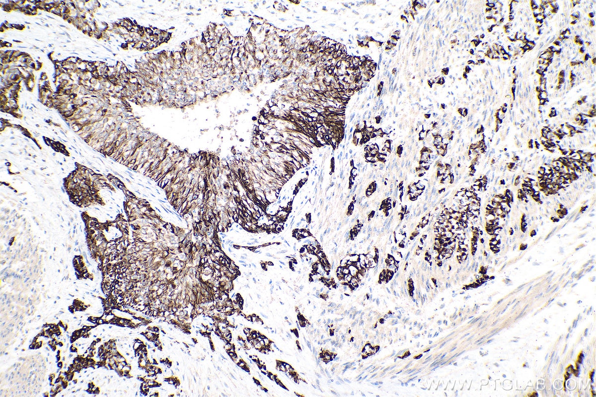 Immunohistochemical analysis of paraffin-embedded human urothelial carcinoma tissue slide using KHC0753 (KRT17 IHC Kit).