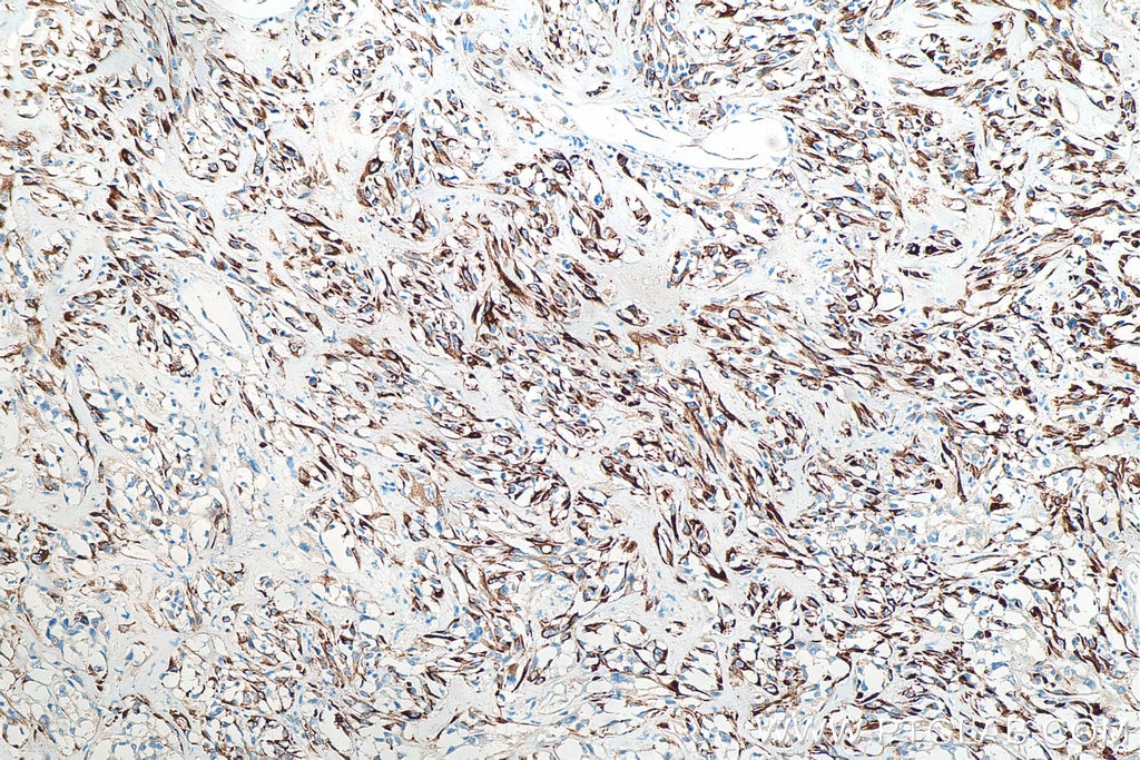 Immunohistochemical analysis of paraffin-embedded human renal cell carcinoma tissue slide using KHC0032 (Cytokeratin 18 IHC Kit).