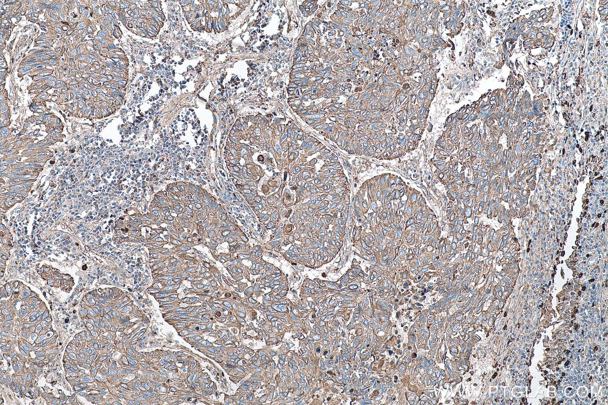 Immunohistochemical analysis of paraffin-embedded human lung cancer tissue slide using KHC0745 (KRT2 IHC Kit).