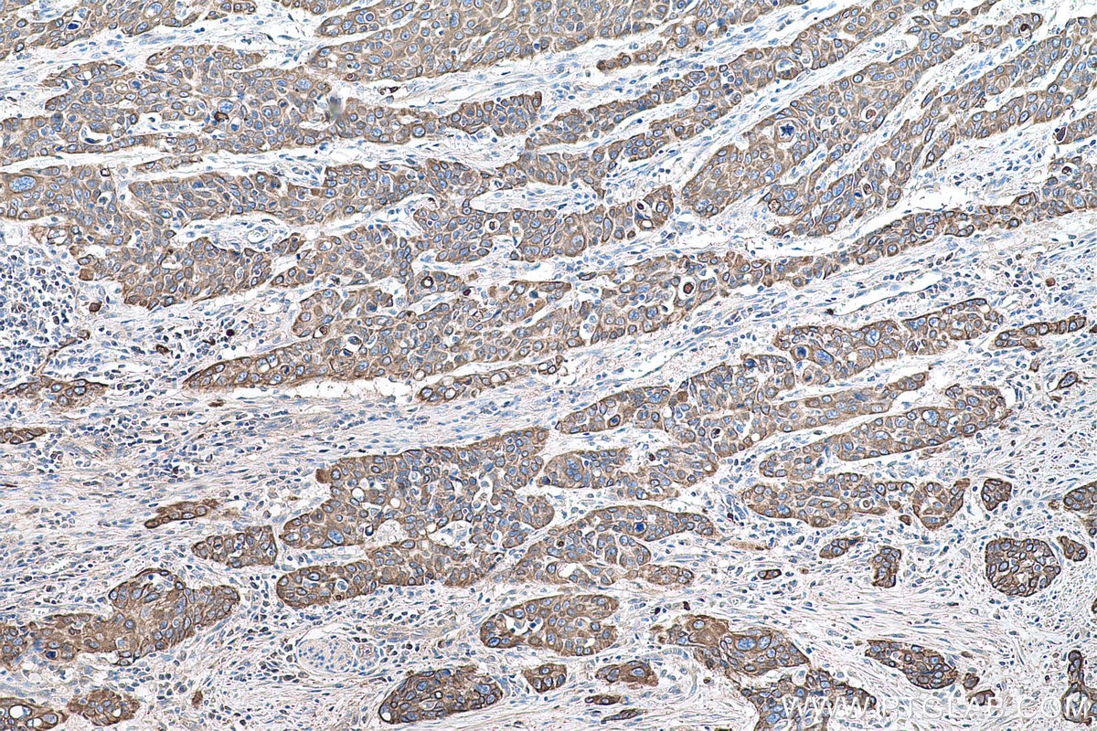 Immunohistochemical analysis of paraffin-embedded human oesophagus cancer tissue slide using KHC0745 (KRT2 IHC Kit).